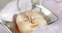 visita con specillo - la carie - studio dentistico Orange Pordenone