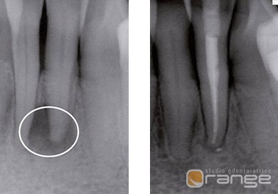 http://studiodentisticoorange.it/wp-content/uploads/2019/01/08-endodontico02.jpg