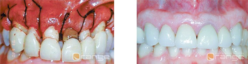 piorrea chirurgia e fine terapia - studio dentistico Orange Maron di Brugnera Pordenone