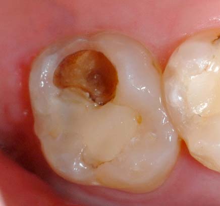 usura cronica del dei denti - studio dentistico Orange Pordenone