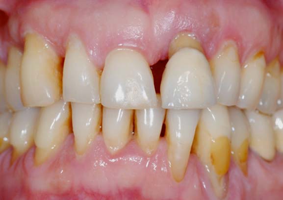 usura cronica del dei denti - studio dentistico Orange Pordenone