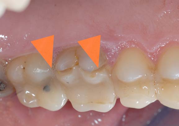 usura dei denti - studio dentistico Orange Pordenone
