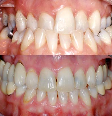 malocclusione dei denti - studio dentistico Orange Pordenone