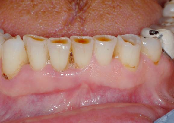 usura cronica del dei denti - studio dentistico Orange Pordenone