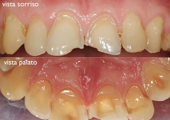 usura dello smalto dei denti - studio dentistico Orange Pordenone