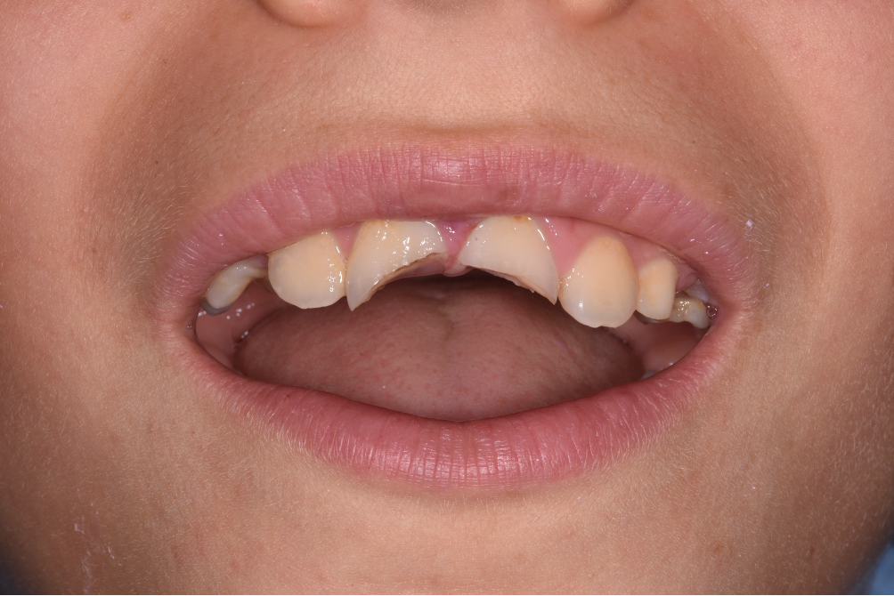 trauma dente bambino pordenone