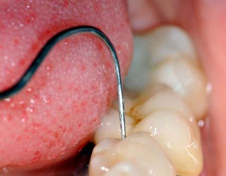 dettaglio strumento sonda parodontale - studio dentistico Orange Pordenone